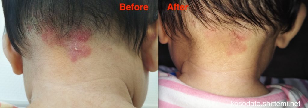 ウンナ母斑のレーザー治療Before＆After
