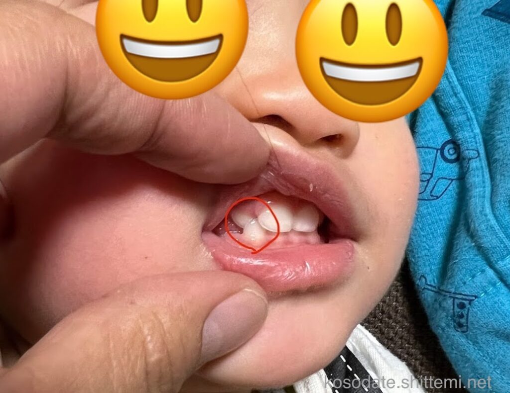 前歯の交叉咬合